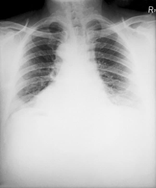 This posteroanterior (PA) chest x-ray was taken 4 mo. after the onset of anthrax in a 46-year-old male.