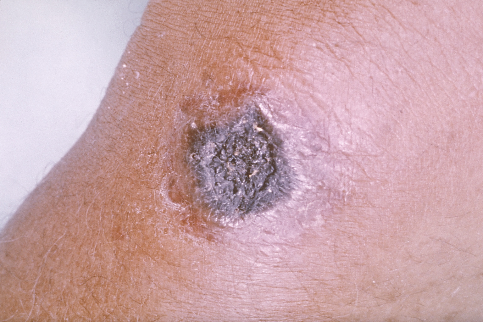 Black sore on an arm showing cutaneous anthrax
