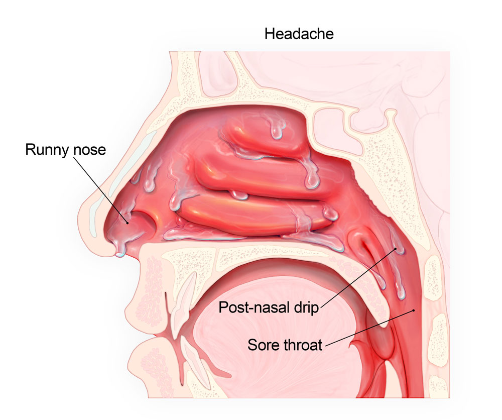 Anatomy of the nasal cavity, pointing out symptoms of the common cold.