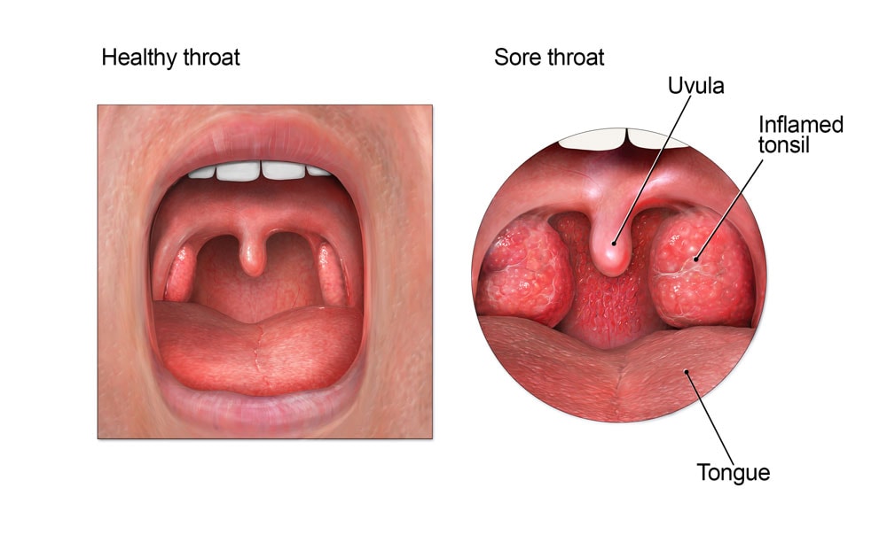 تشريح الفم ، يظهر التهاب اللوزتين في الحلق.