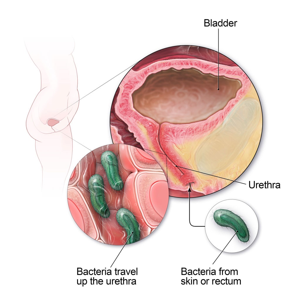 In females, bacteria from the skin or rectum can travel up the urethra and cause a bladder infection.