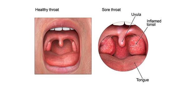 Sore Throat | Antibiotic Use | CDC