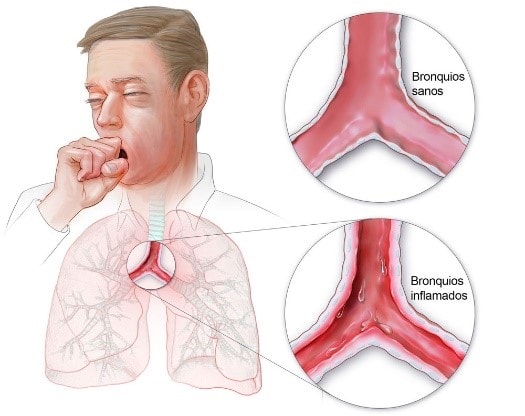 regular Alivio Cancelar Bronquitis aguda (resfriado de pecho) | Prescripción y uso de antibióticos  | CDC