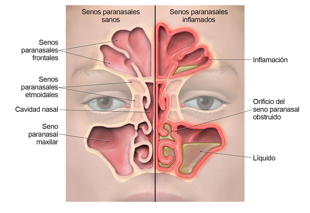 Diagrama de los senos paranasales que muestra dónde ocurre la inflamación y dónde se acumula el líquido durante la sinusitis.
