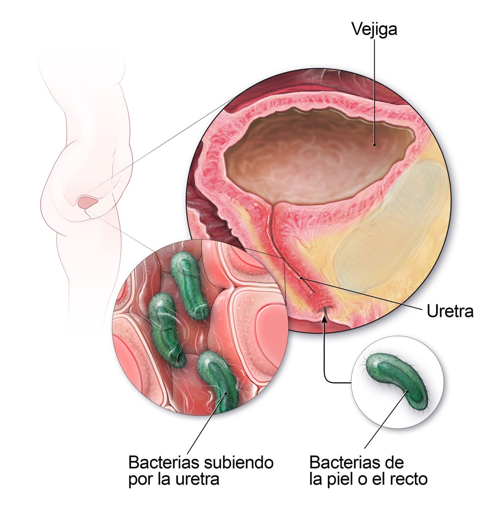 Vías urinarias de la mujer, incluidas la vejiga y la uretra. Esta imagen muestra cómo las bacterias en la piel o el recto pueden subir por la uretra y causar una infección de vejiga.