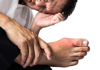 Asian man with painful and inflamed gout in his foot.