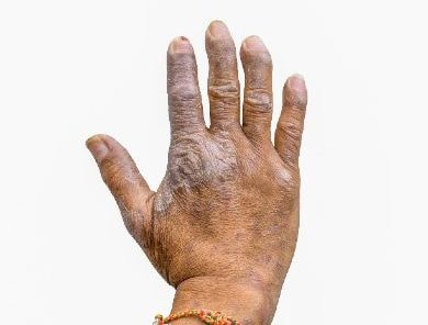 Hand of person with psoriasis