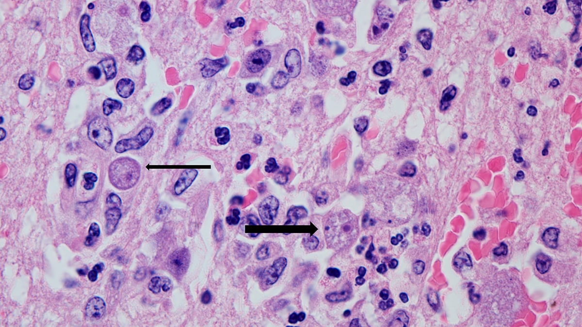 Balamuthia amebas in a person's brain. A thick arrow points to the infectious form of the ameba. A thin arrow points to a developing cyst, the dormant, non-infectious form.