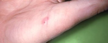 A persons hand with an infected scratch near the thumb