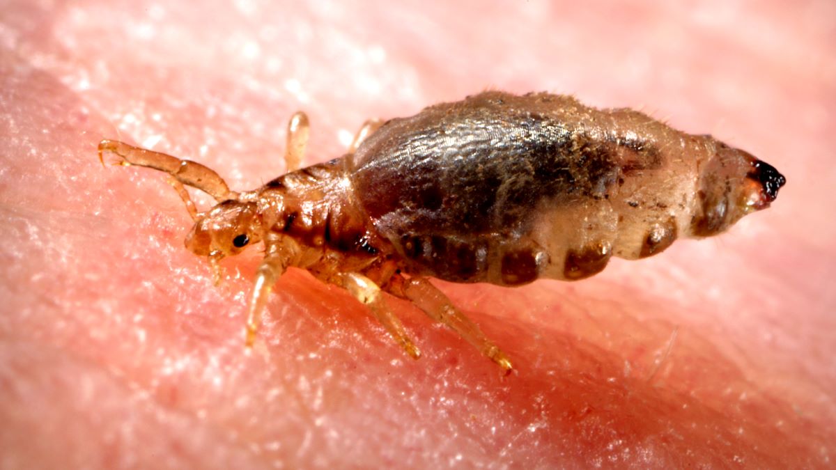 Body louse on human skin.