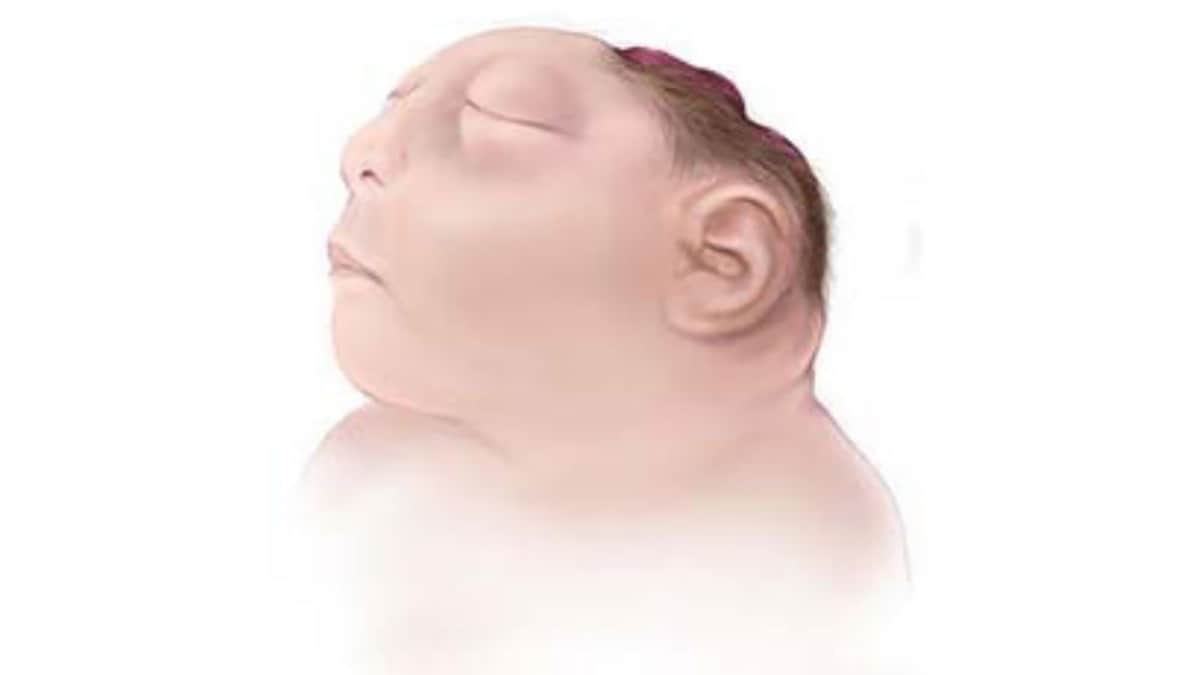 Ilustración de un bebé con anencefalia, al que le faltan partes del cerebro y el cráneo.