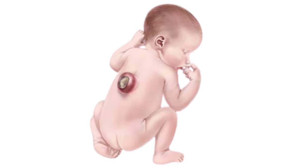 Ilustración de un bebé con espina bífida.