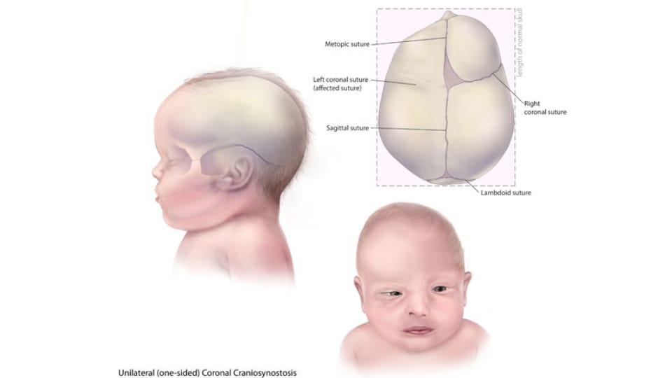 Imagen de un bebé con craneosinostosis coronal unilateral (en un solo lado).