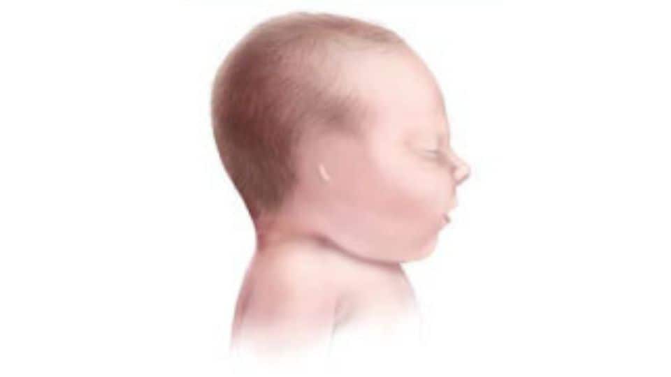Ilustración de un bebé con anotia: sin oído externo.