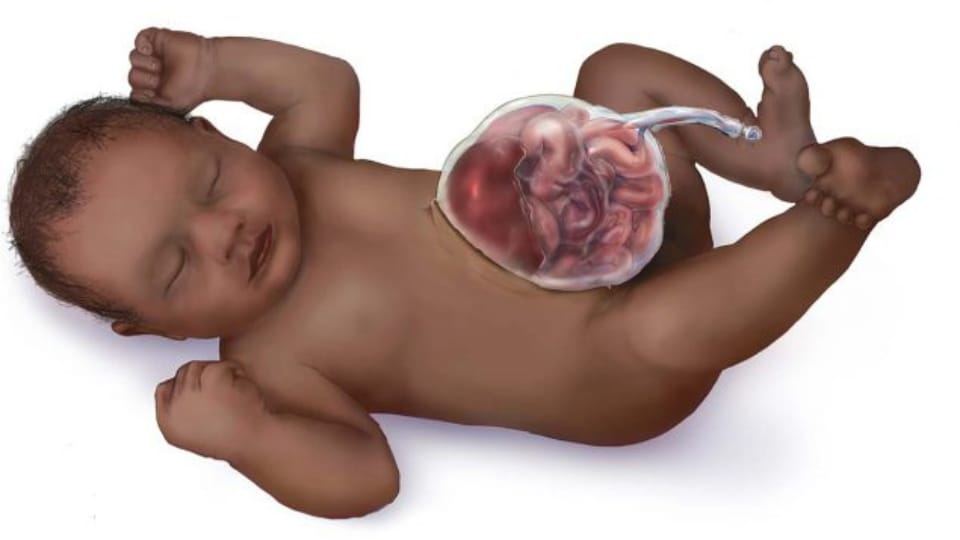 Illustration of infant with omphalocele.