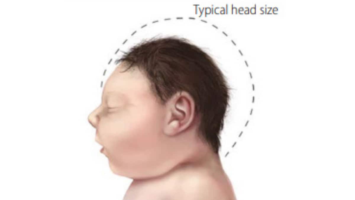 Ilustración de un bebé con microcefalia, con una línea dibujada alrededor de su cabeza para compararla con la forma y el tamaño típicos de la cabeza.
