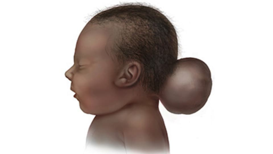 Ilustración de un bebé con encefalocele occipital, con la protrusión desde la parte de atrás de la cabeza.