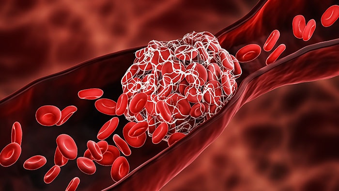 Illustration of a blood clot blocking the red blood cells stream.