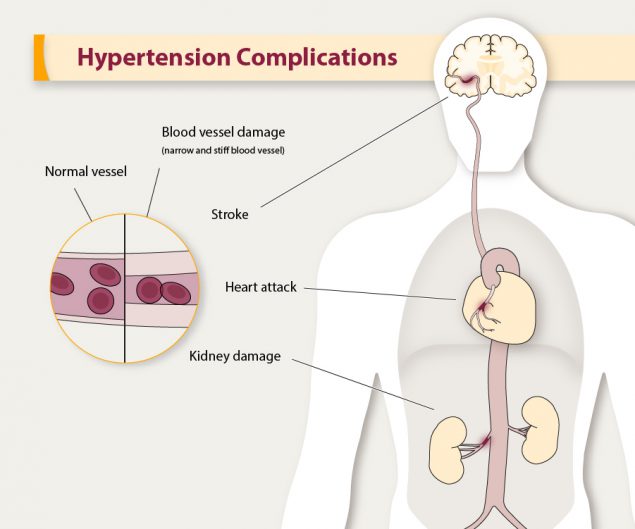 high blood pressure symptoms and signs