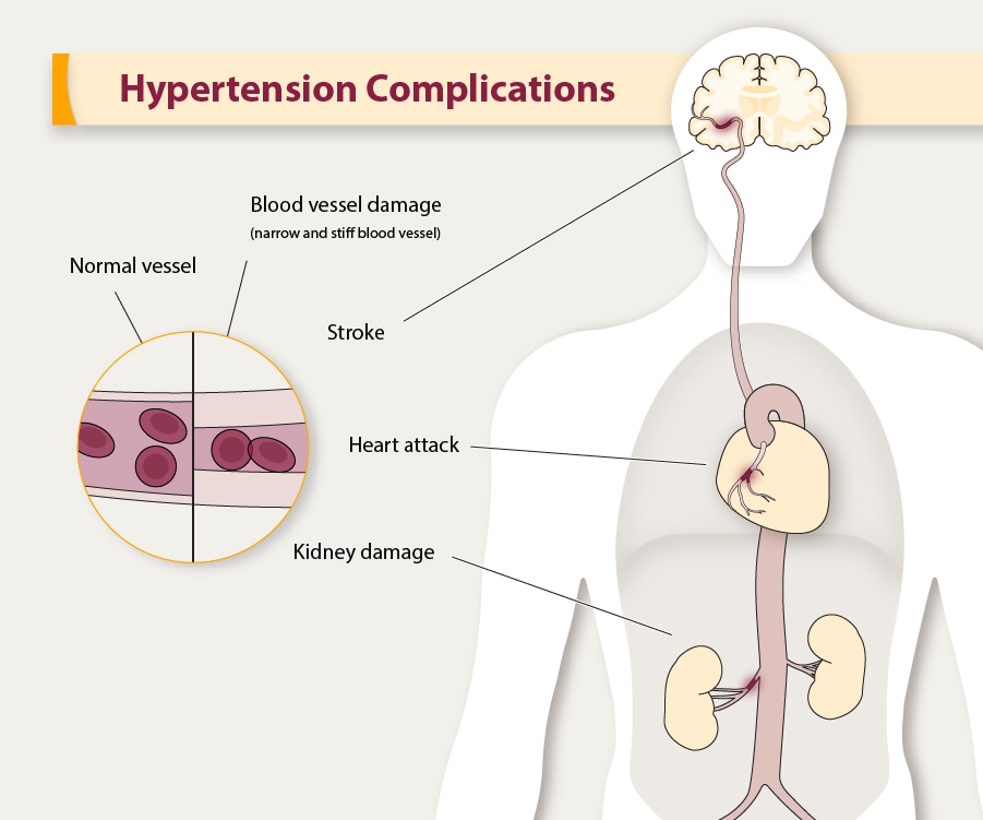 Hypertension complications: stroke, heart attack, kidney damage.