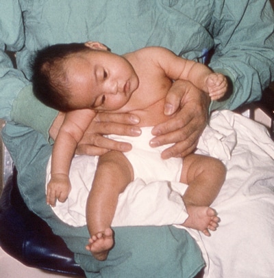 Patient with infant botulism displaying a loss of muscle tone.