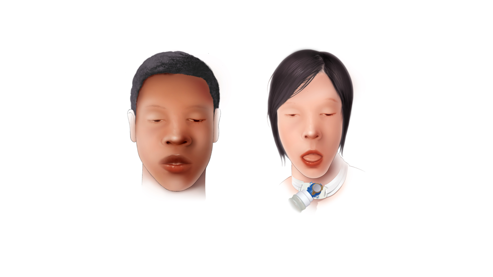 Renderings of two people with botulism.