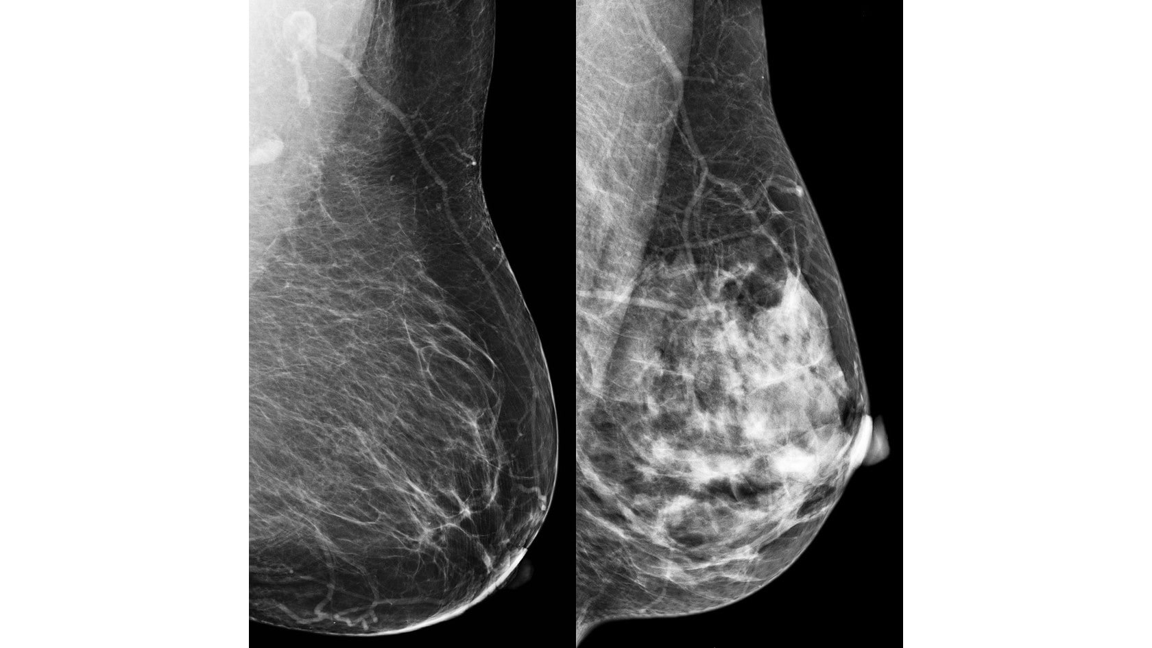 Two mammograms showing a fatty breast and a dense breast