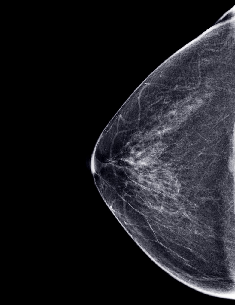 a mammogram