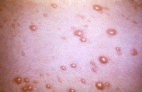 This photograph depicted a close view of a patient’s skin surface, revealing the presence of a pustular-vesicular rash, which was attributed to a generalized herpes zoster outbreak, due to the varicella-zoster virus (VZV) pathogen.