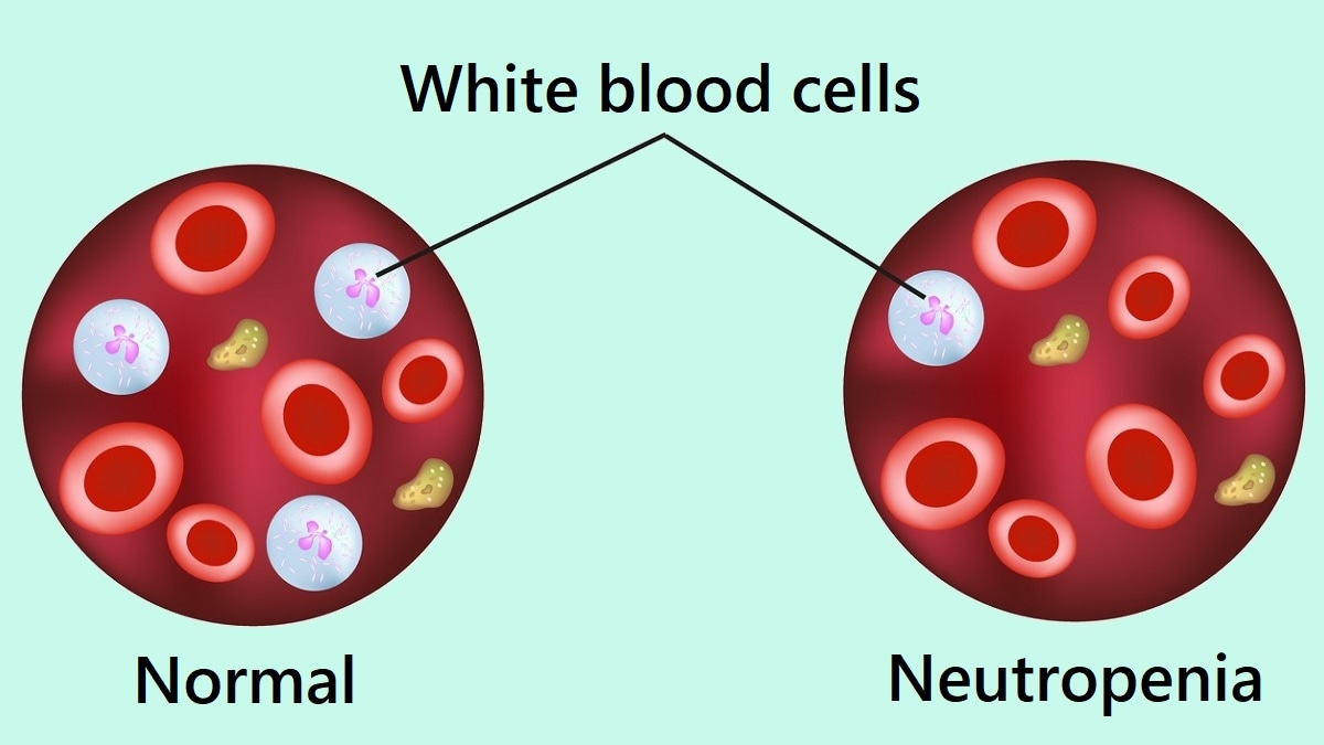 Normal white blood cells and neutropenia