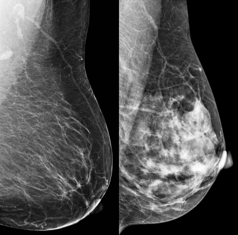 اثنان من تصوير الثدي بالأشعة السينية