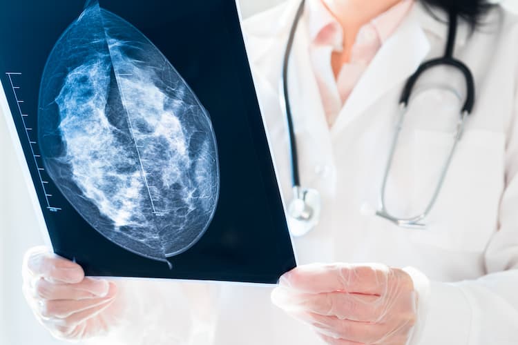 Photo of a doctor looking at mammography results on an x-ray