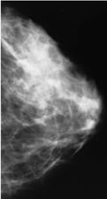 An example of a normal mammogram.