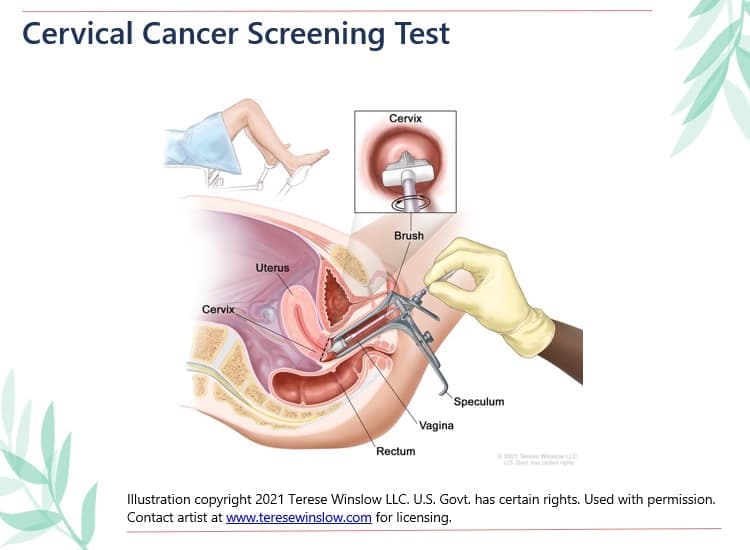 Diagram of a cervical cancer screening test