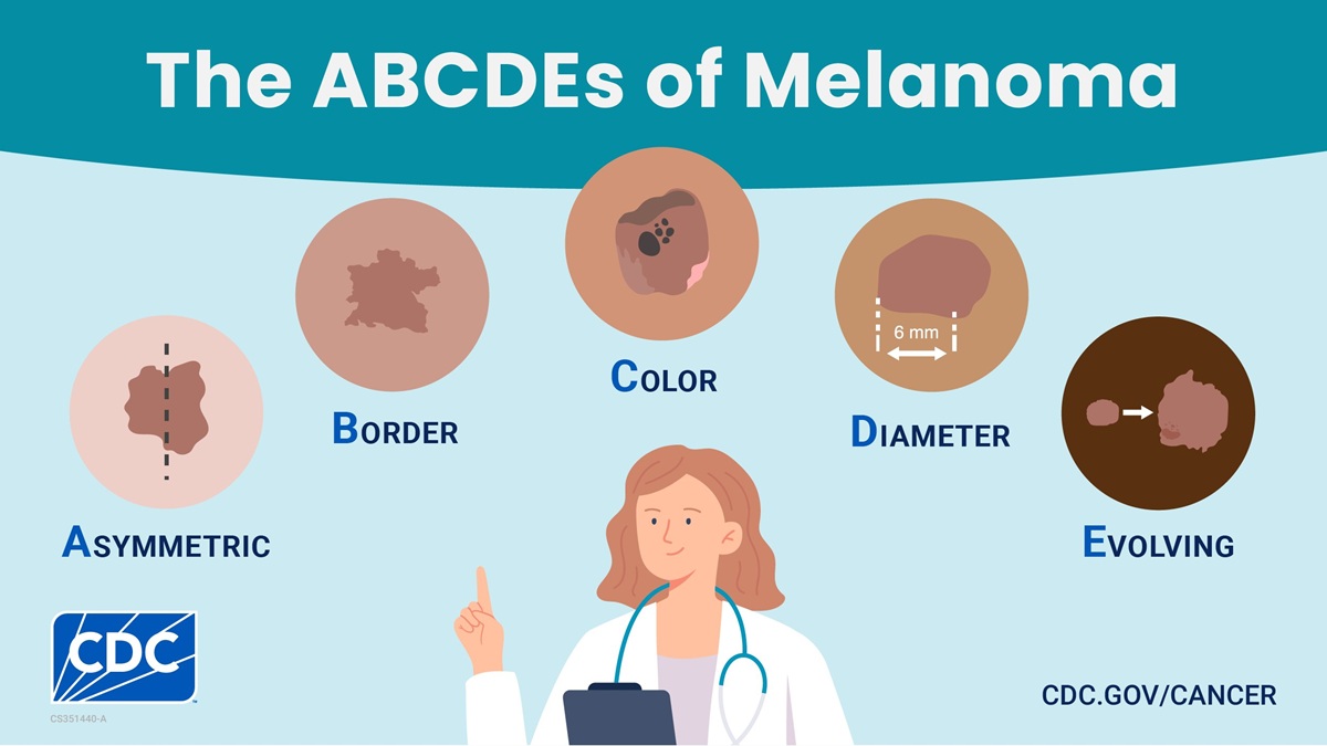 Rectangular image: The ABCDEs of melanoma: asymmetric, border, color, diameter, evolving