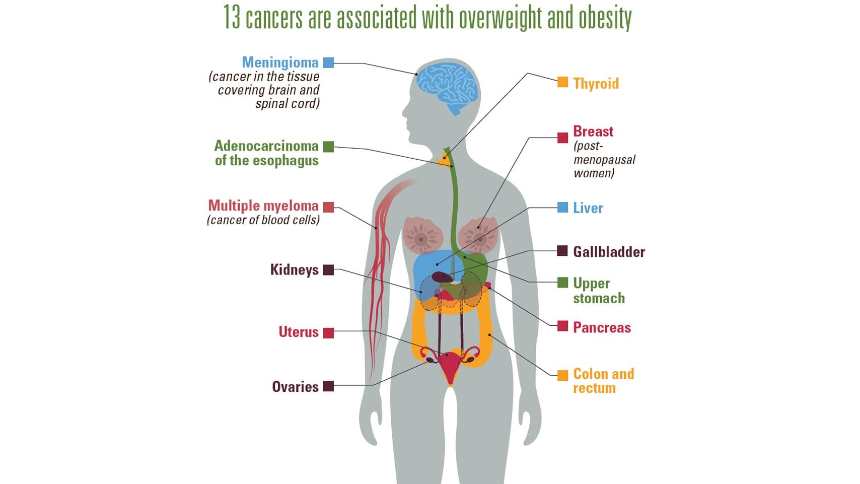 13 cancers are associated with overweight and obesity: meningioma (cancer in the tissue covering brain and spinal cord); adenocarcinoma of the esophagus; multiple myeloma (cancer of blood cells); kidneys; uterus; ovaries; thyroid; breast (in post-menopausal women); liver; gallbladder; upper stomach; pancreas; and colon and rectum.