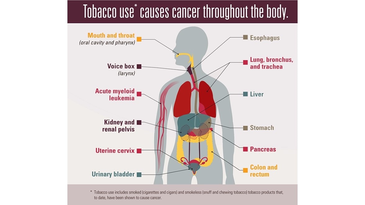Tobacco use causes cancer throughout the body. Tobacco use includes smoked (cigarettes and cigars) and smokeless (snuff and chewing tobacco) tobacco products that have been shown to cause cancer.