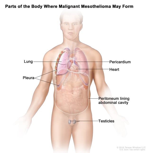 Drawing shows parts of the body where malignant mesothelioma may form.