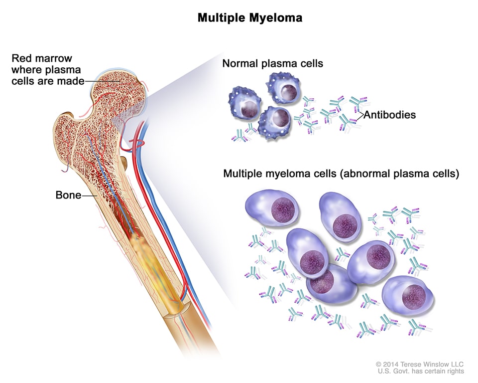 global market for multiple myeloma treatment