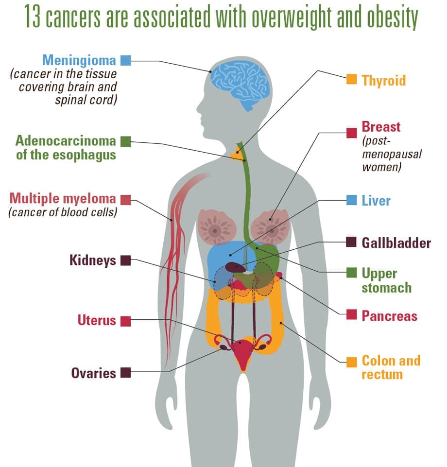 13 cancers are associated with overweight and obesity: meningioma (cancer in the tissue covering brain and spinal cord); adenocarcinoma of the esophagus; multiple myeloma (cancer of blood cells); kidneys; uterus; ovaries; thyroid; breast (in post-menopausal women); liver; gallbladder; upper stomach; pancreas; and colon and rectum.