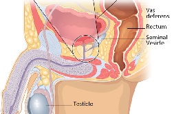 prostate cancer screening cdc