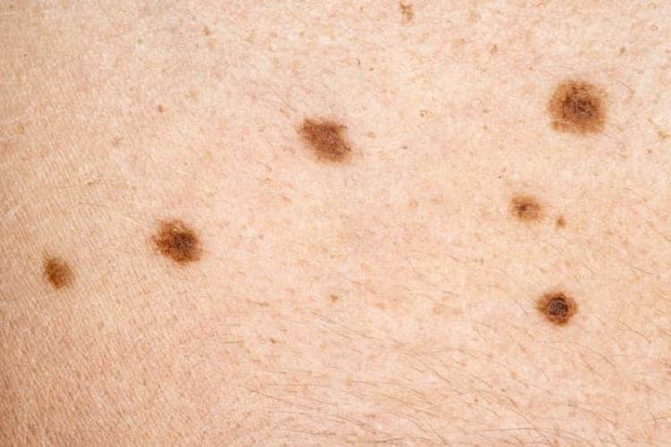 Photo of skin moles or spots.
