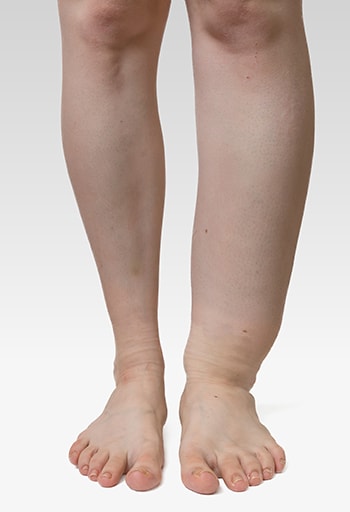 Photo of a person with lymphedema in the left leg.