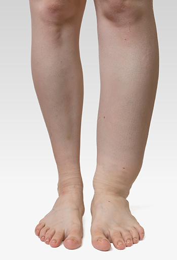 What Is Lymphedema