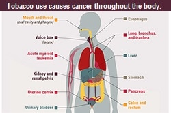 吸煙會導致全身癌症。 口和喉（口腔和咽）； 食管;  語音信箱（喉）； 肺，支氣管和氣管； 急性髓性白血病； 肝;  腎臟和腎盂； 胃;  子宮頸  胰腺;  結腸和直腸； 和膀胱。 煙草使用包括熏制的（香煙和雪茄）和無菸的（鼻煙和咀嚼煙草）煙草產品，迄今為止，這些產品已被證明會引起癌症。