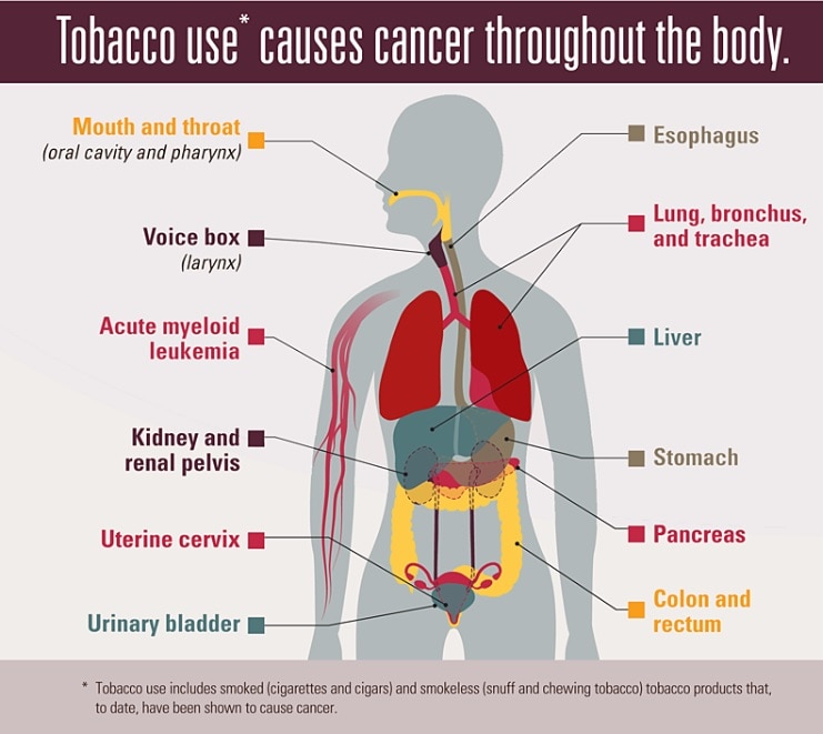 Tobacco use causes cancer throughout the body: mouth and throat (oral cavity and pharynx); voice box (larynx); esophagus, lung, bronchus, and trachea; stomach; kidney and renal pelvis; pancreas; liver; urinary bladder; uterine cervix; colon and rectum; and acute myeloid leukemia. Tobacco use includes smoked (cigarettes and cigars) and smokeless (snuff and chewing tobacco) tobacco products that have been shown to cause cancer.