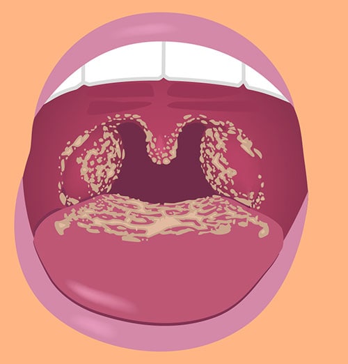 Illustration of open mouth with white patches on the tongue and throat