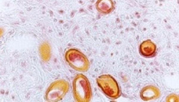 Capillaryasis About Capillariasis | Capillariasis | CDC