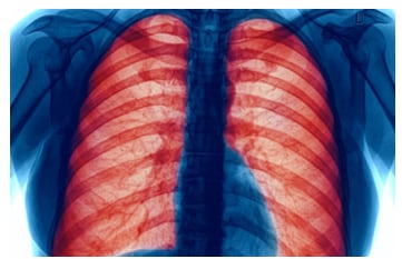 Lungs Xray