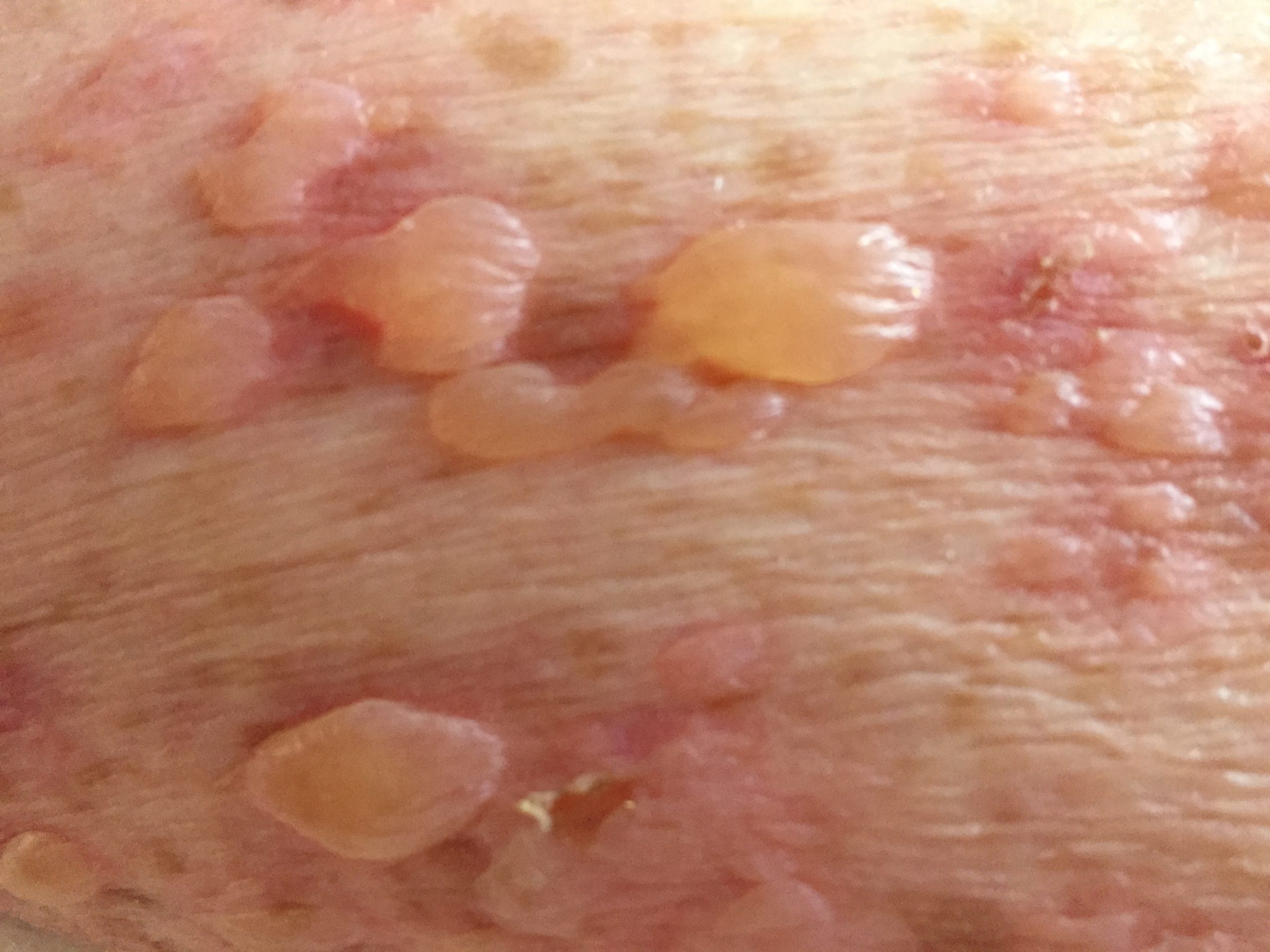Embossed Skin Rash Vesicants | CTTL | CDC